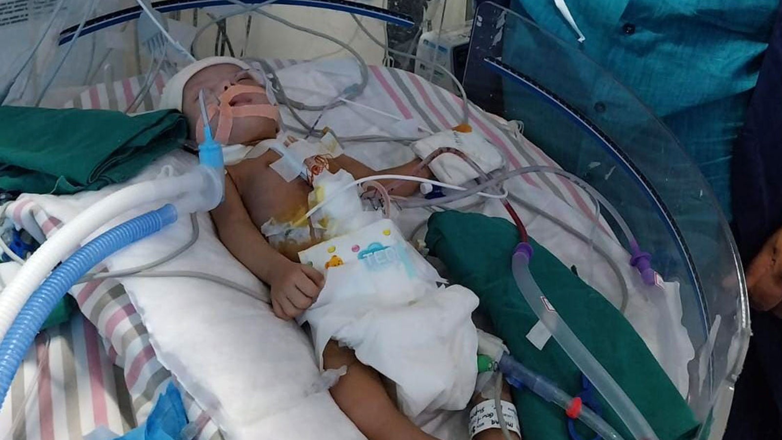 HEALTH: Infant from our child care centre recuperating after major cardiac surgery